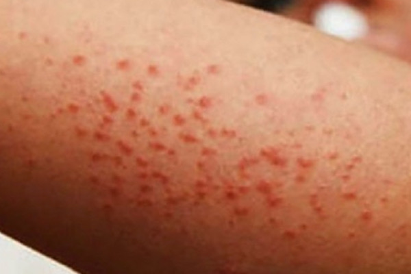 Confirman primer caso de Sarampión en Hidalgo